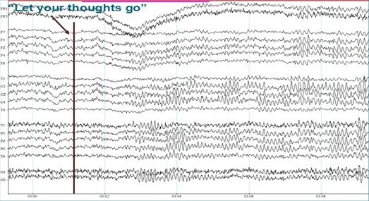 eeg 2012年 Unpredictable Nature of Alpha Brain Waves During an EEG Recording