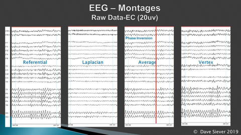 EEG Montages in Multi-channel Hyper-coherent Alpha